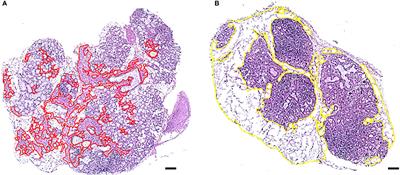 Inflammatory Stratification in Primary Sjögren’s Syndrome Reveals Novel Immune Cell Alterations in Patients’ Minor Salivary Glands